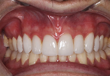 after-orthodonticsand-veneers
