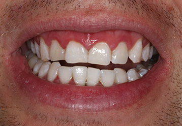 after-teeth-whitening-cases