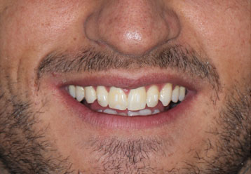 before-orthodonticsand-veneers