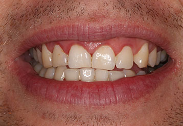 before-teeth-whitening-cases