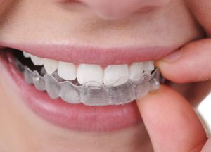 orthodontics-and-invisalign