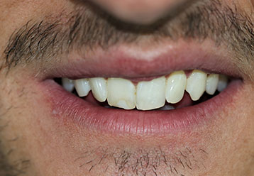 orthodonticsand-veneers-gallery-1
