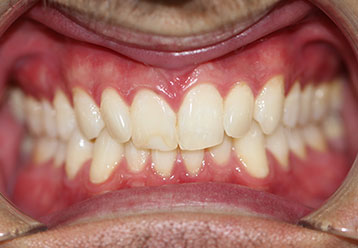 orthodonticsand-veneers-gallery-2
