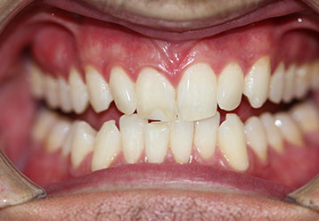 orthodonticsand-veneers-gallery-3