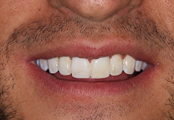 orthodonticsand-veneers-gallery-4