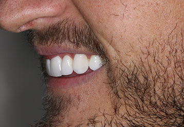 orthodonticsand-veneers-gallery-6