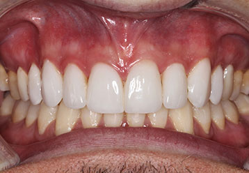 orthodonticsand-veneers-gallery-7