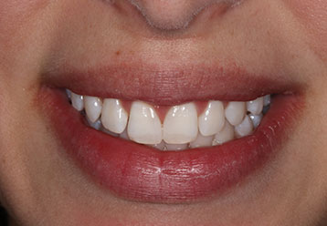 teeth-whitening-cases-gallery-1