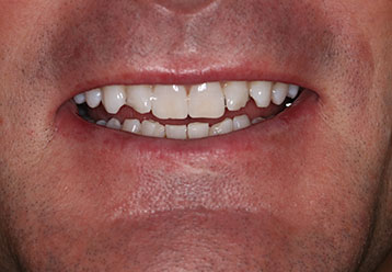 teeth-whitening-cases-gallery-11