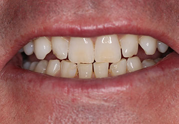 teeth-whitening-cases-gallery-12