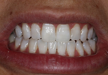 teeth-whitening-cases-gallery-13