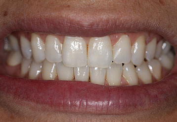 teeth-whitening-cases-gallery-14