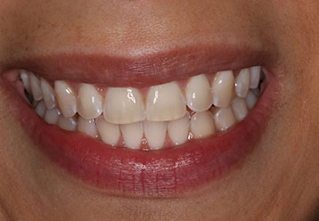 teeth-whitening-cases-gallery-3