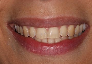 teeth-whitening-cases-gallery-4
