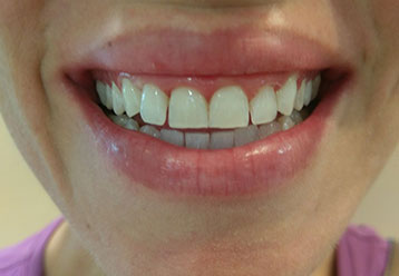 teeth-whitening-cases-gallery-7