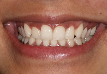 teeth-whitening-cases-gallery-8