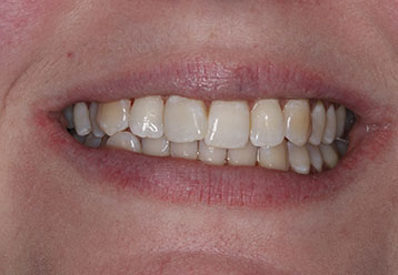 teeth-whitening-cases-gallery-9