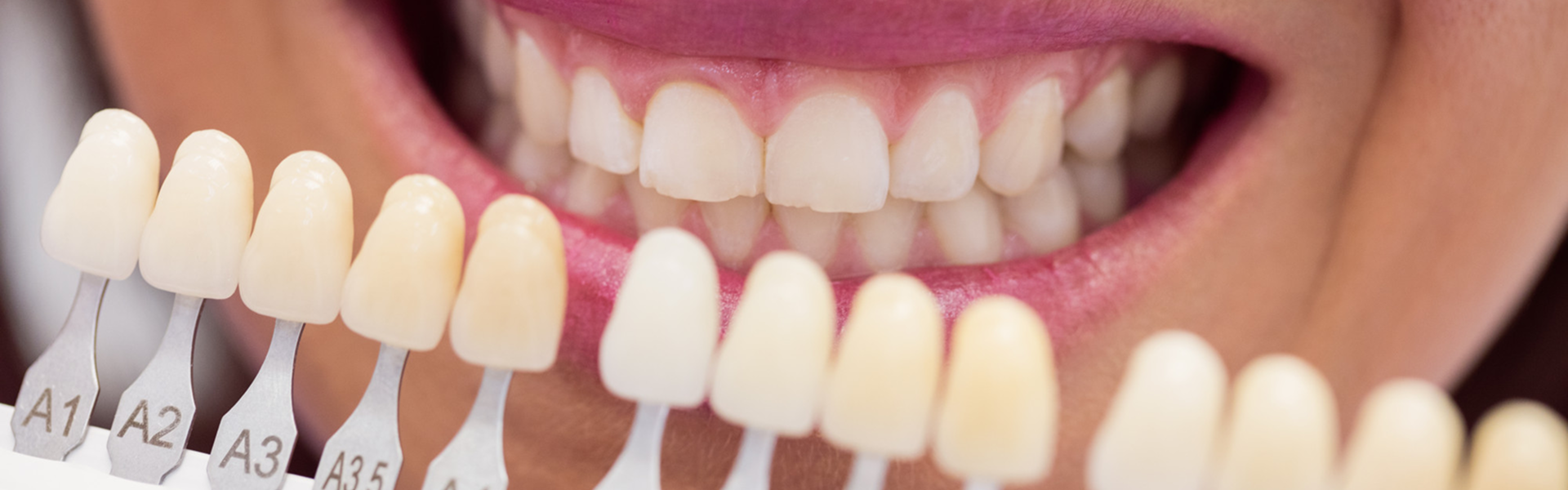 Whitening- In Chair Vs Take Home Whitening - 1
