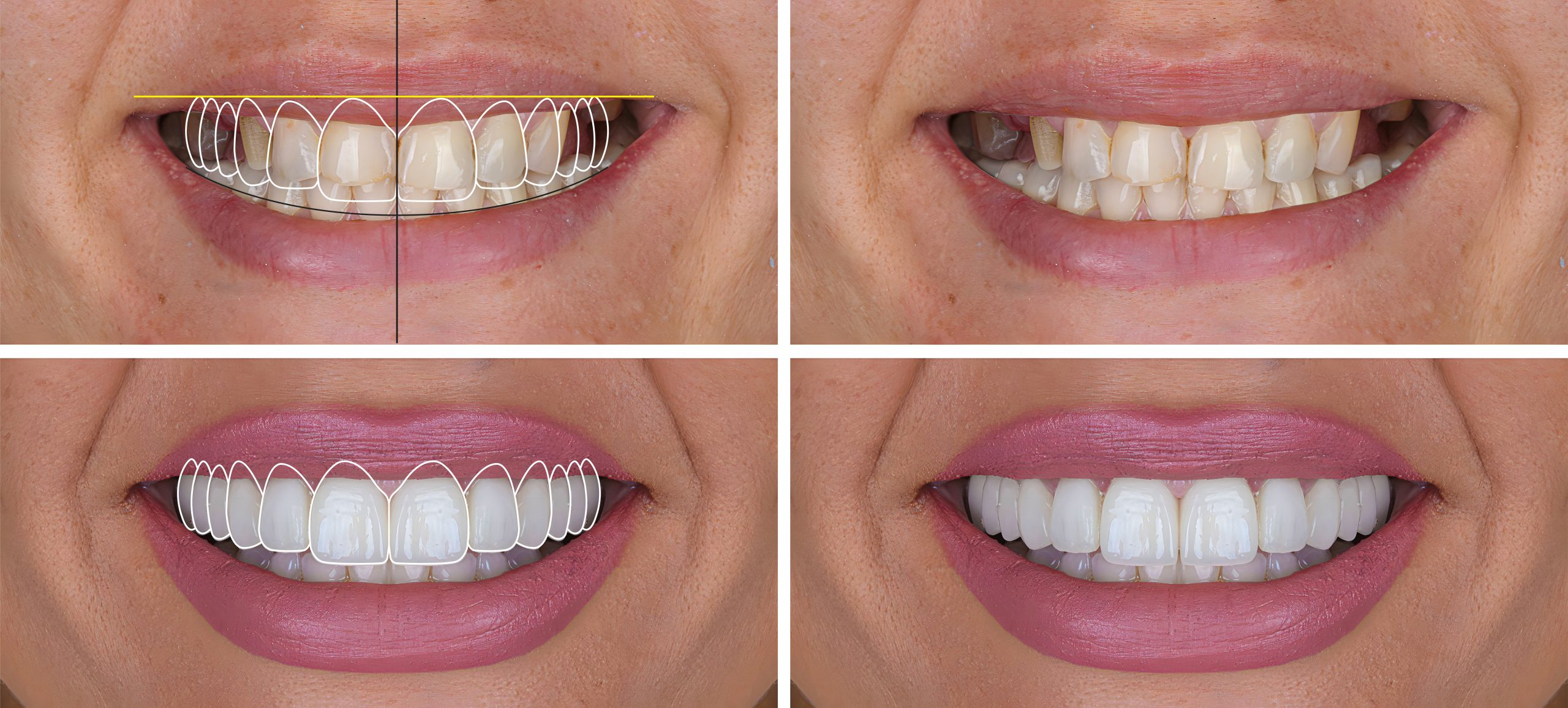 before and after smile makeover showing teeth alignment and whitening improvements