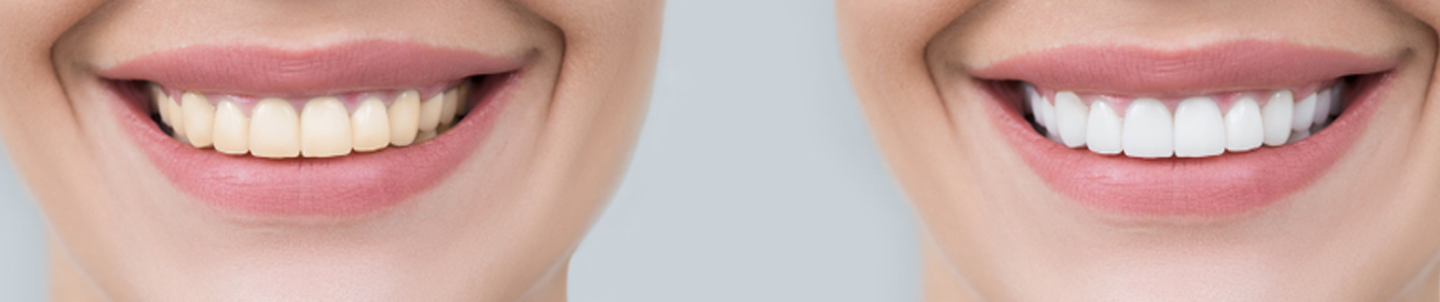 Teeth Whitening Cases